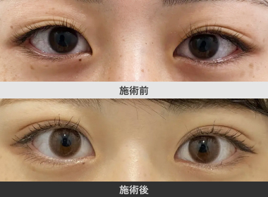 まぶた脂肪取り