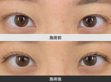 ハーブ二重術2点留め