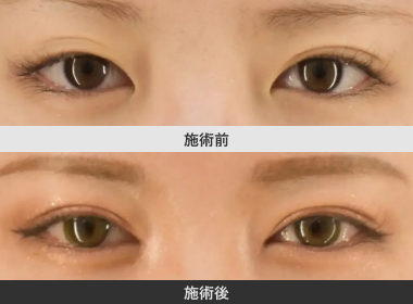 全開切開法二重