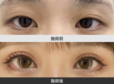 全開切開法二重