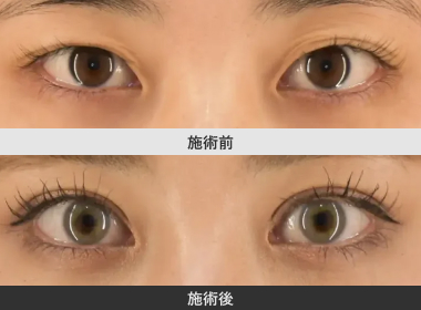 目つき矯正