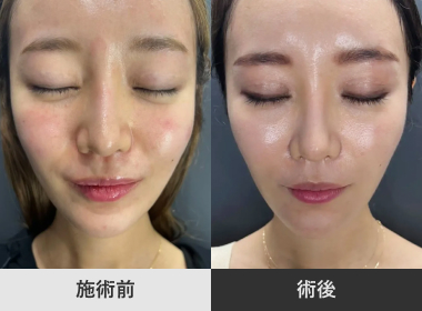 糸リフト ドリームスレッド4本