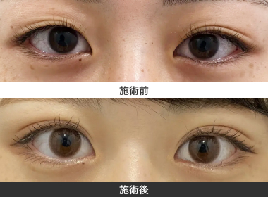 まぶた脂肪取り