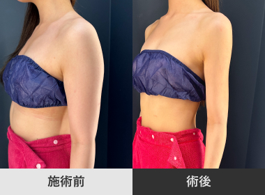 二の腕脂肪吸引