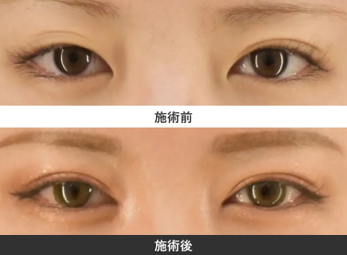 全開切開法二重