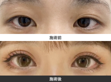 全開切開法二重