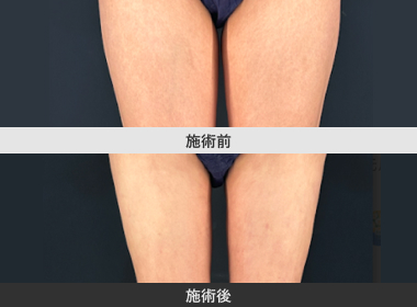 太もも脂肪吸引