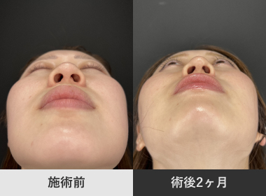小鼻縮小・鼻尖形成