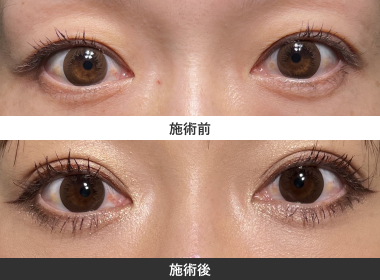 目の下のクマ治療