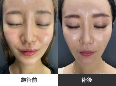 糸リフト ドリームスレッド4本