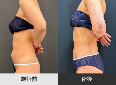 腹部脂肪吸引