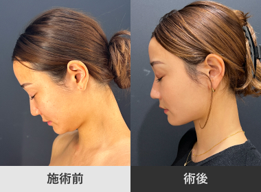 頬・顎下脂肪吸引