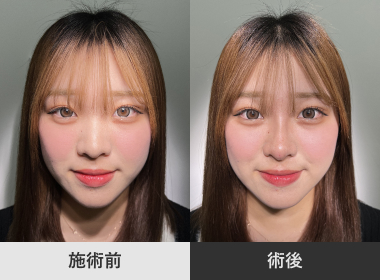 鼻ヒアルロン酸